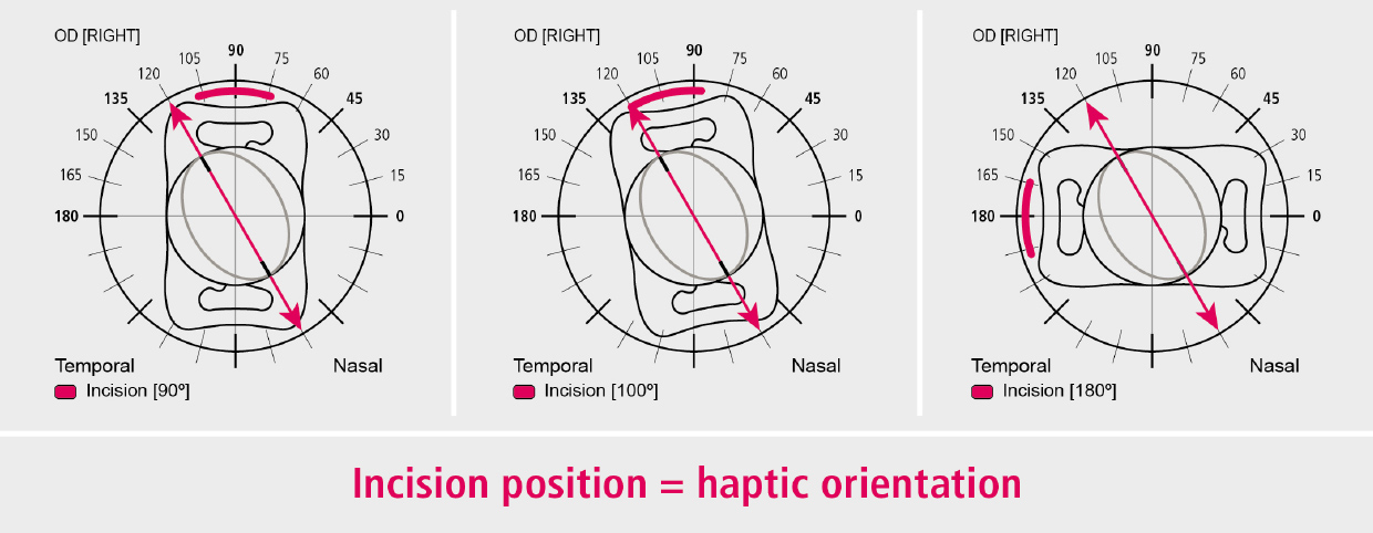 Abb. Incision position EN