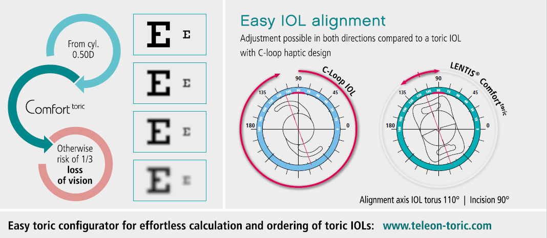 Abb. Easy IOL alignment