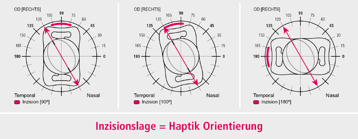 Abb. Inzisionslage DE